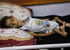 دراسة الأونروا في مجلة لانسيت: ارتفاع مقلق لسوء التغذية بين أطفال غزة