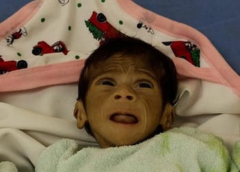 الأمم المتحدة: معدلات “مذهلة” لسوء التغذية الحاد بين أطفال غزة