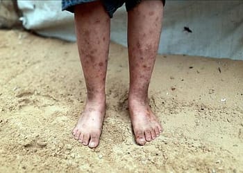 غزة – ارتفاع حالات الإصابة بالأمراض الجلدية في مواقع النزوح