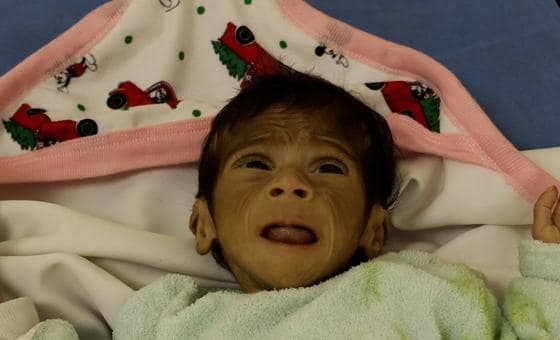 الأمم المتحدة: معدلات “مذهلة” لسوء التغذية الحاد بين أطفال غزة