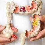 مشروبات مفيدة للأمعاء تساعد في تقليل خطر الإصابة بسرطان القولون