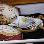 دراسة الأونروا في مجلة لانسيت: ارتفاع مقلق لسوء التغذية بين أطفال غزة